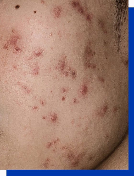 Acne nodules or Cysts