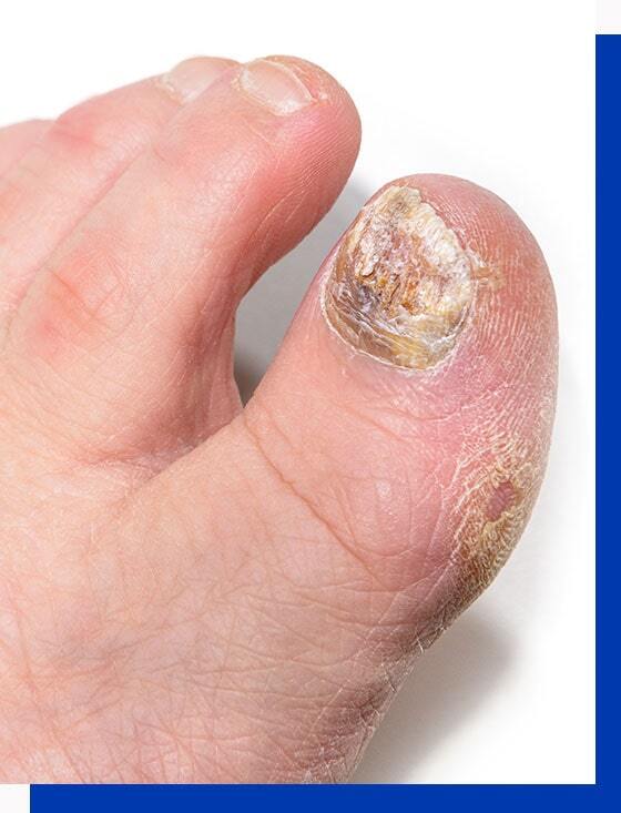 WHAT IS ONYCHOMYCOSIS? Onychomycosis, or nail infection, is a persistent  fungal infection of the nail bed, matrix or plate. It is the mos... |  Instagram