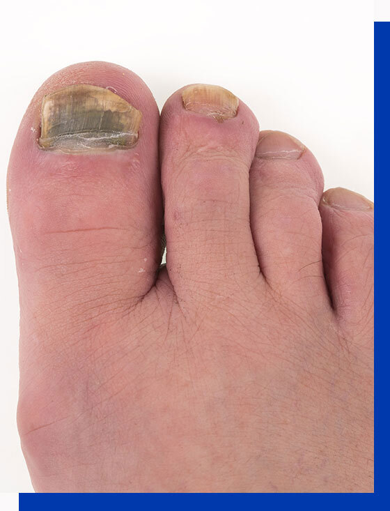 Nail psoriasis