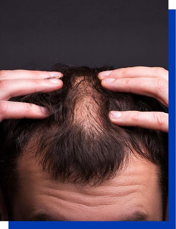 Patchy bald spots