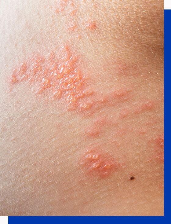 Plaque Psoriasis