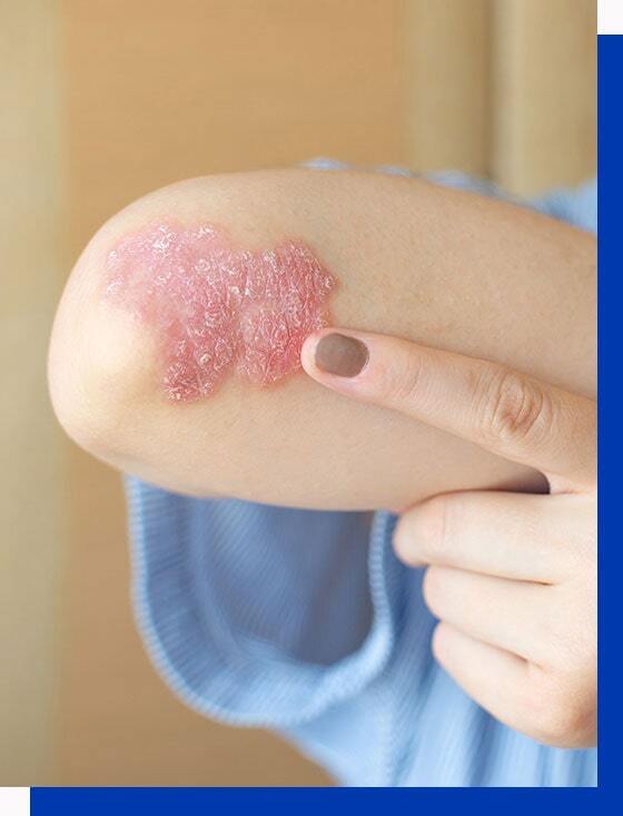 Pustular psoriasis